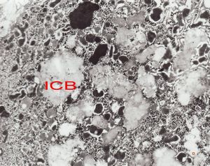 F,7m. | giant cell hepatitis- intracellular cholestasis F,7m. | giant cell hepatitis- intracellular cholestasis